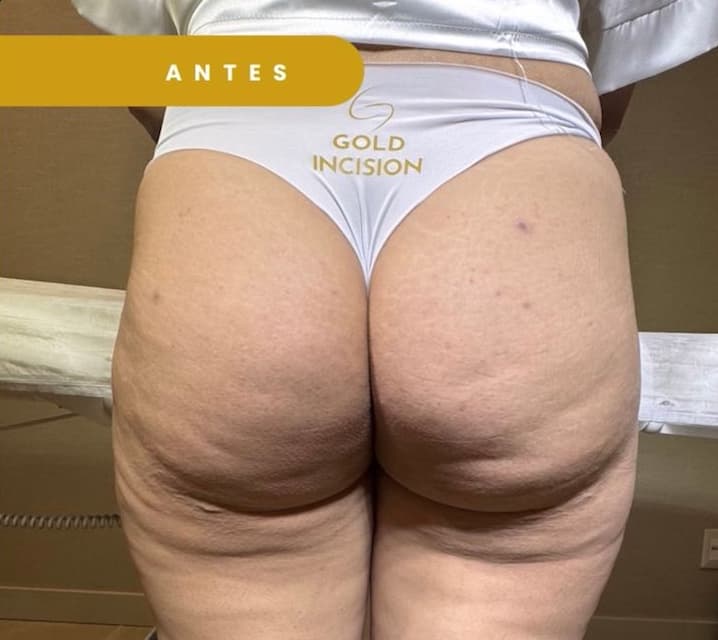 Goldincision - Caso 7 - Antes