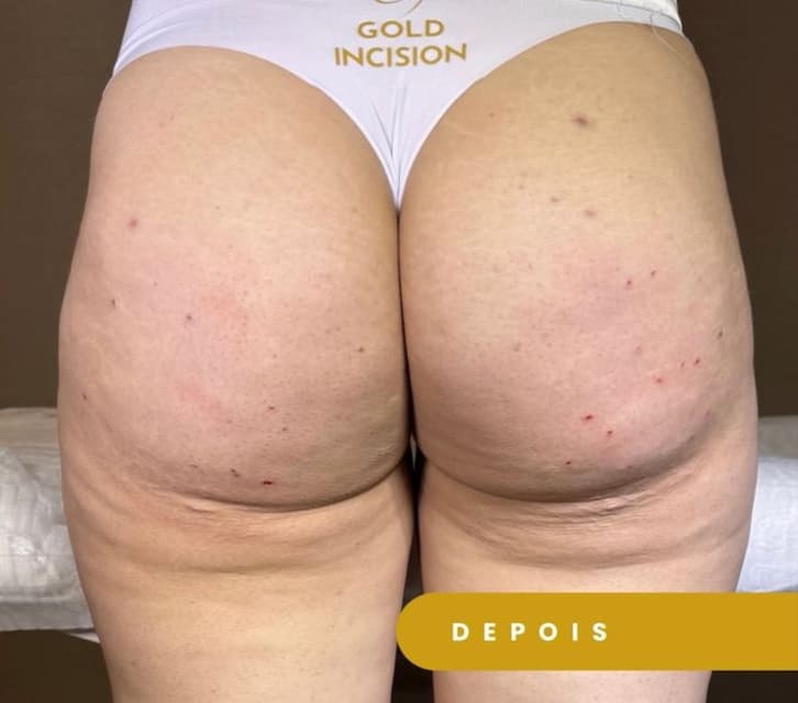 Goldincision - Caso 7 - Depois